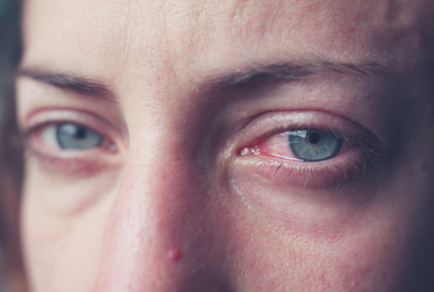 Woman having red eyes