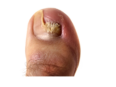 Understanding Toenail Fungus: Causes and Symptoms