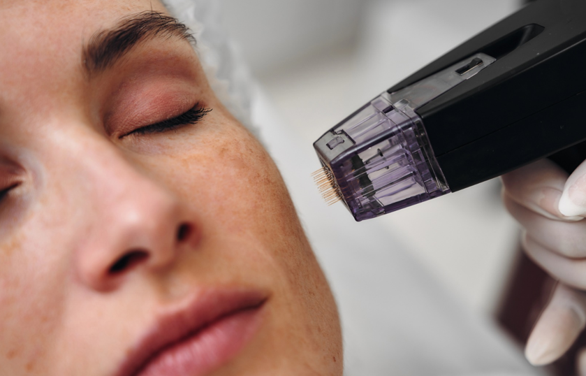 A woman with closed eyes undergoing a facial microneedling treatment.