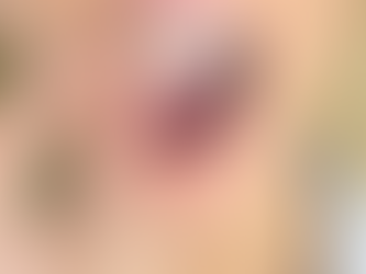 Custom vs. Over-the-Counter Mouth Guards: Which Option Best Protects Your Smile in Calgary