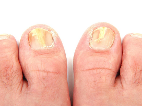 How Laser Treatment Works for Toenail Fungus
