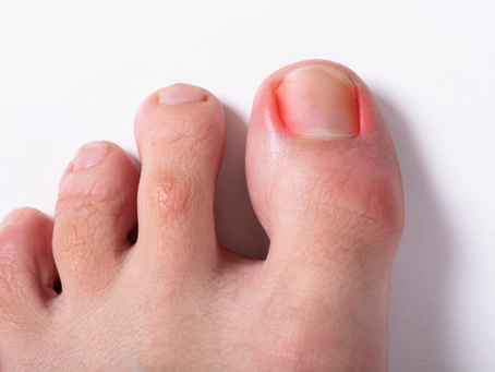 In-office Surgery for Ingrown Toenails: What to Expect