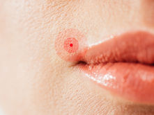 cropped view of herpes on lips of sick woman