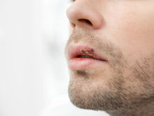 cold sores herpes, oral sex transmission 