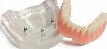 dentier sur implants rosemère