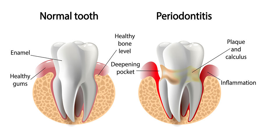 Image of normal healthy tooth vs gum disease (periodontitis)