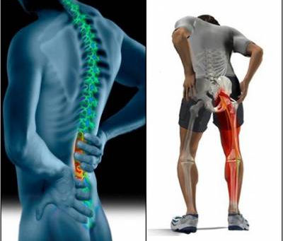 O que é a Dor no Nervo Ciático (Ciatalgia)?