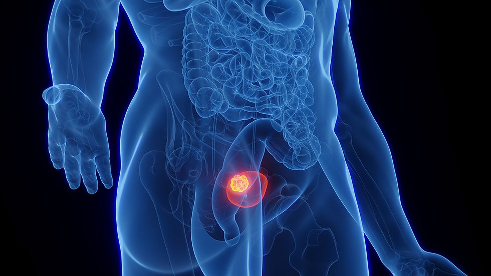 cancer de bexiga.jpeg