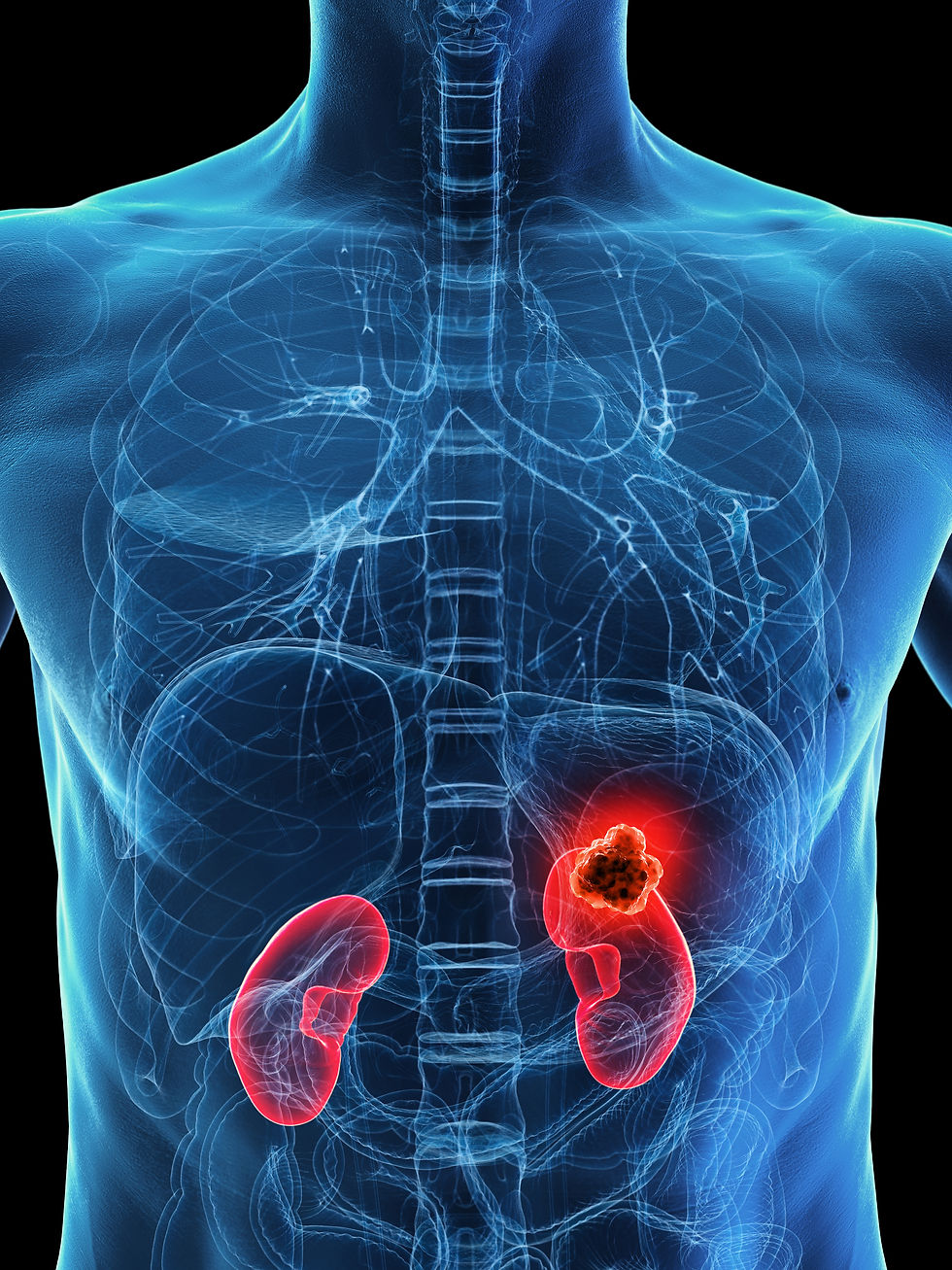 cancer de rim.jpeg