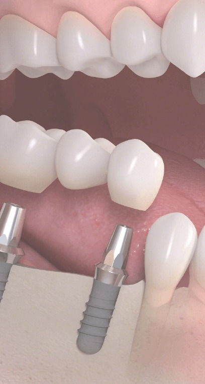 implant-tedavisi_edited.jpg