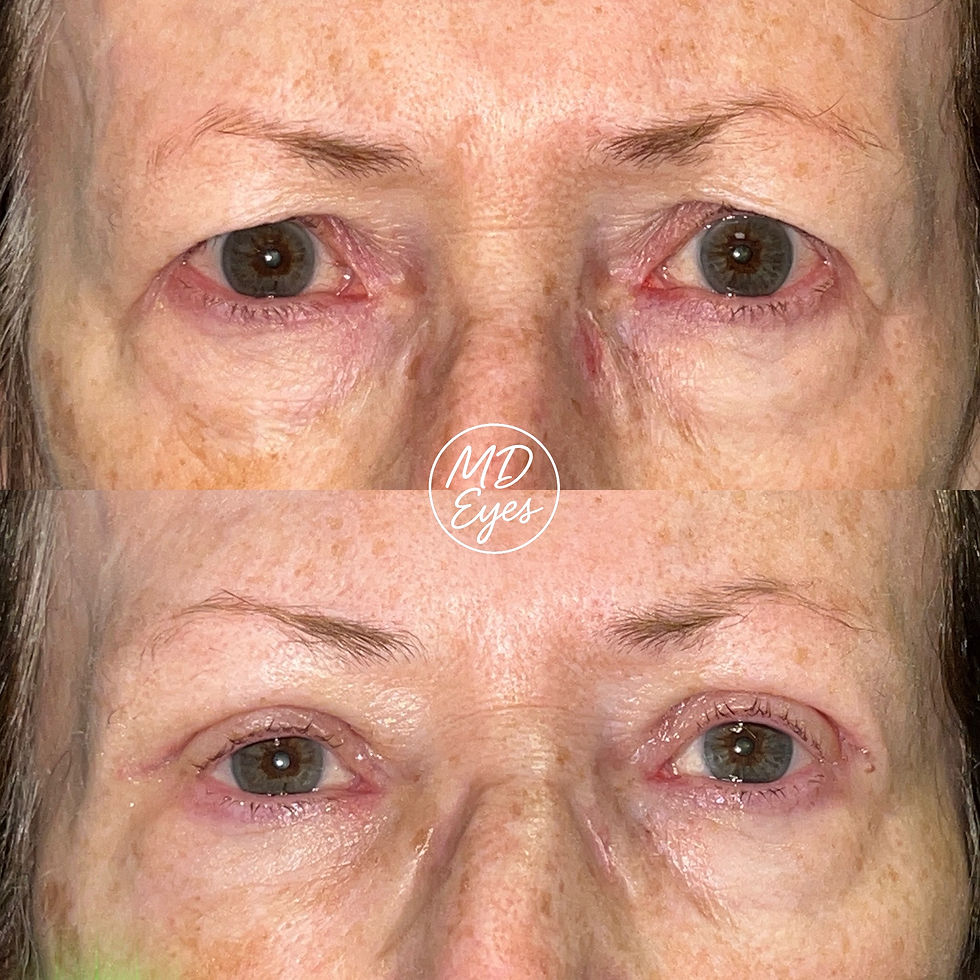 Upper lid blepharoplasty + Brow Augmentation