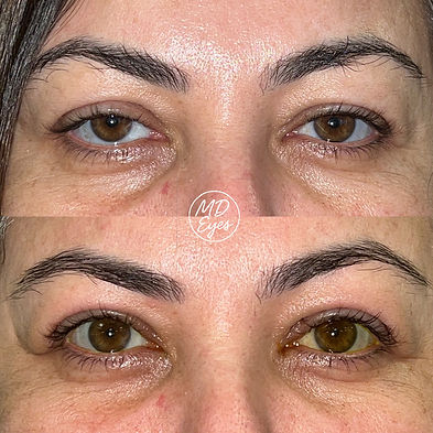 Ptosis + Bleph.jpeg