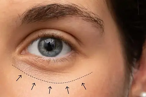 lower-eyelid-retraction-surgery.webp