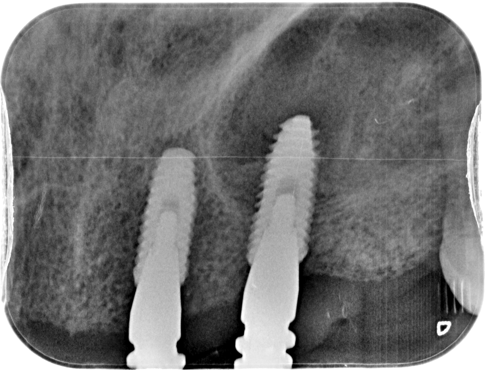 Restoration of Maxillary bridge with deep sulcus ultilising Multi unit abutments content media