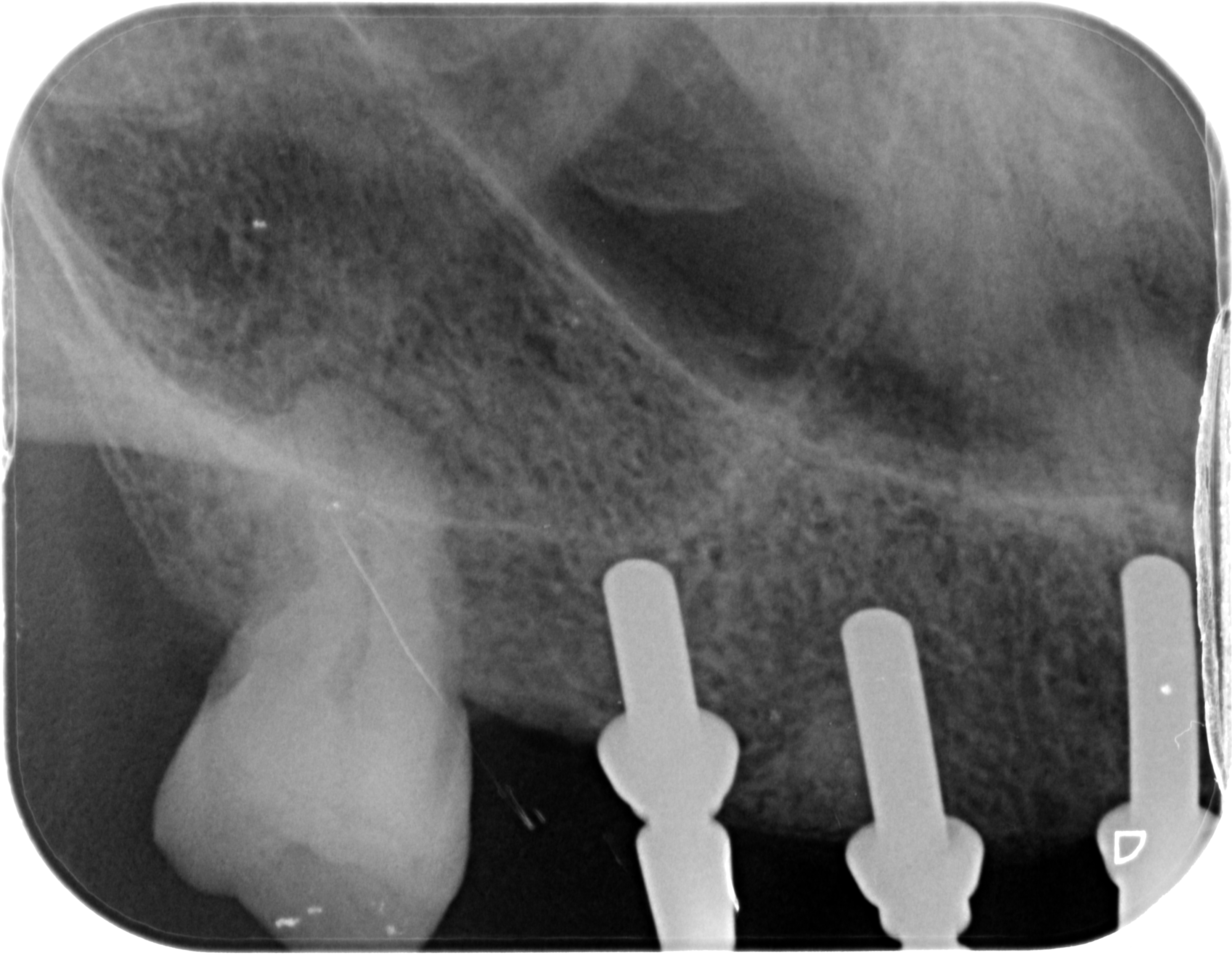 Screw retained bridges ultilising Neobiotech Non Hexed Abutments content media