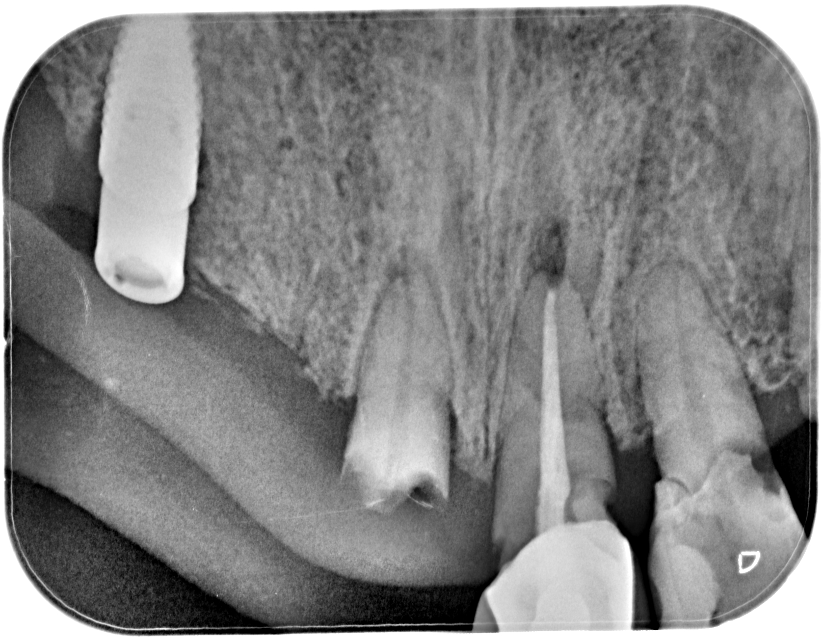 REHABITATION OF MAXILLA with full arch zirconia screw retained bridges after staged grafts content media