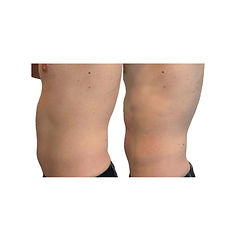EmSculpt results on tummy