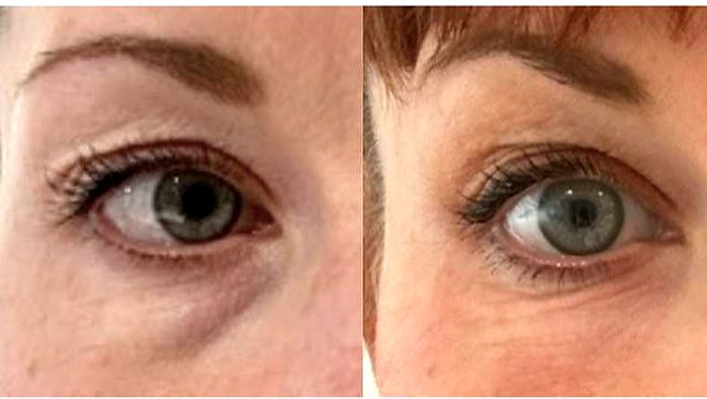 Combined HIFU with CO2 laser