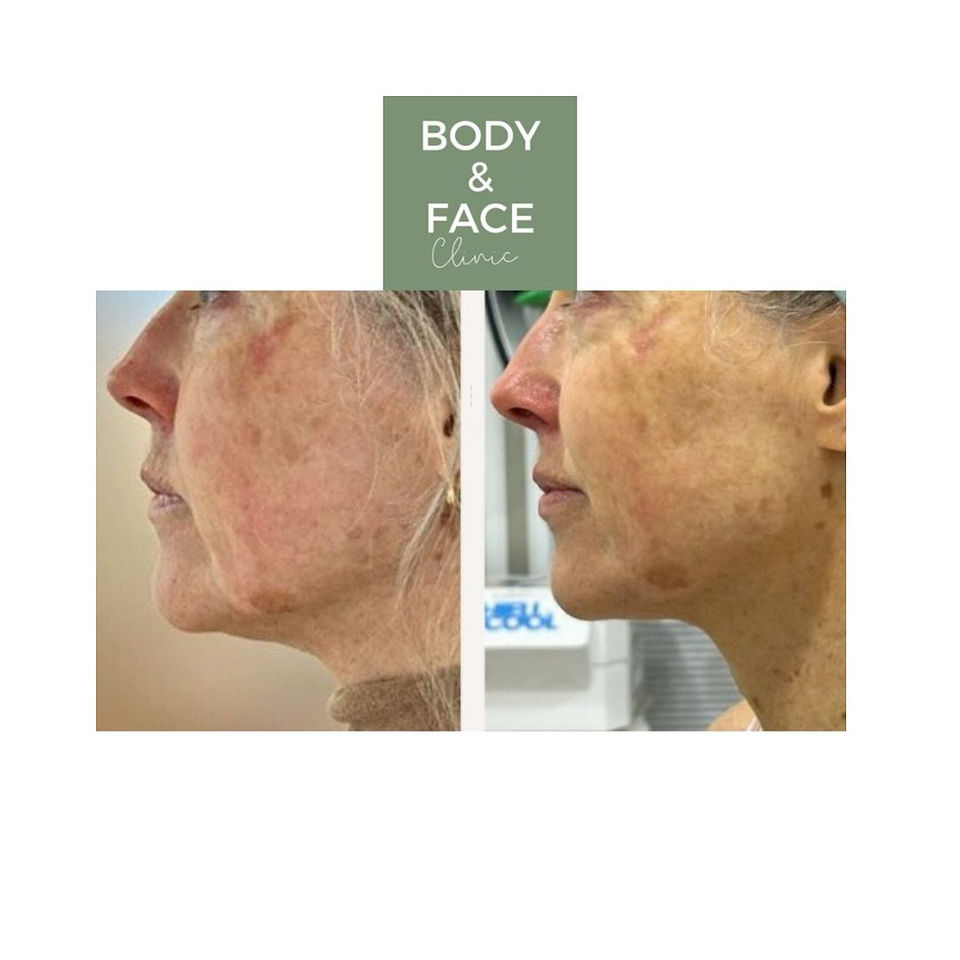 HIFU & Face Peel Treatment