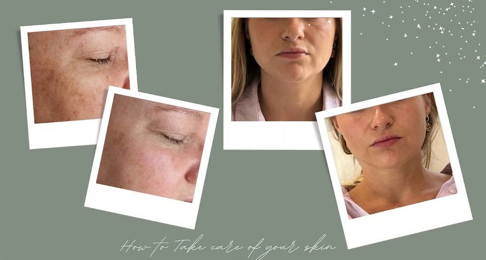 Before and afters of two clients having had laser skin rejuvenation
