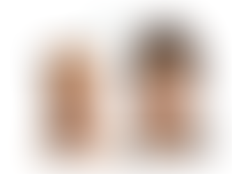 33% Off Dermal Fillers & Our Upcoming Face Makeover