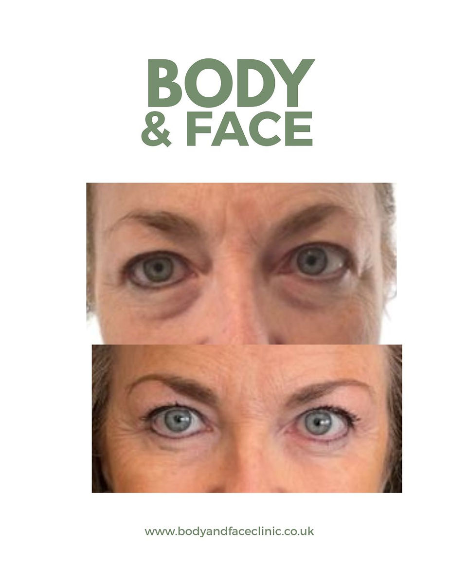 woman non-surgcial blepharoplasty