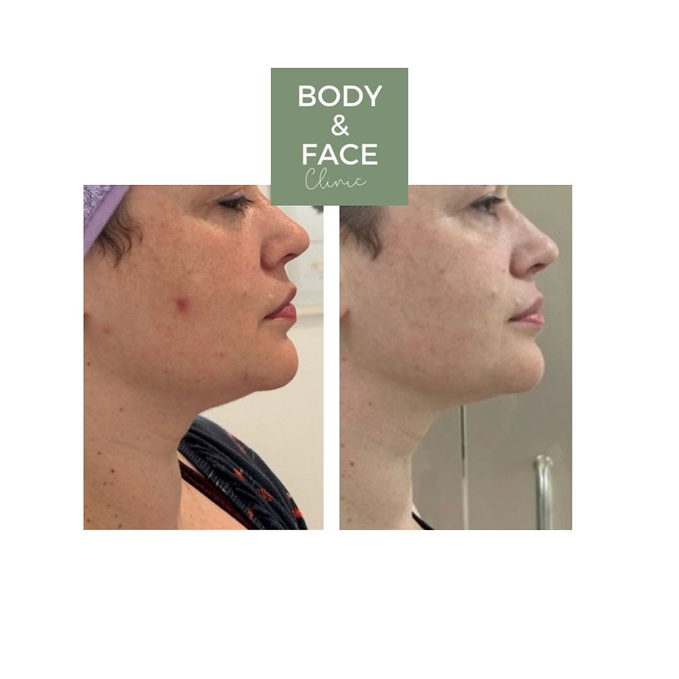 non-surgical face and neck lift