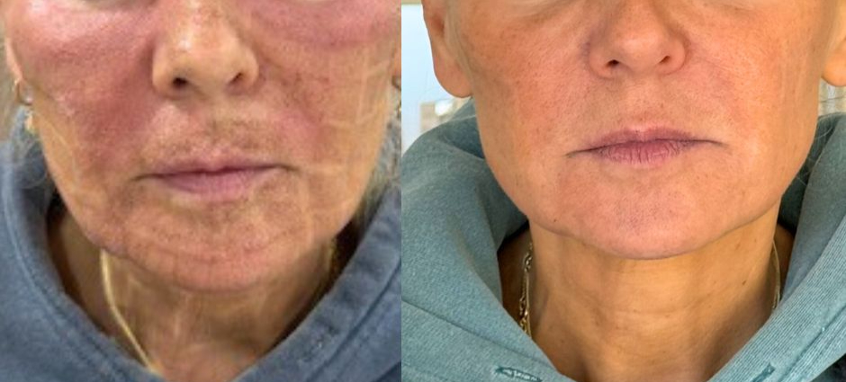 woman after CO2 laser treatment