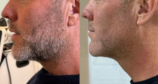 Man before and after face and neck treatment
