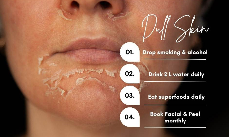 Face peeling after a facial peel