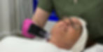 woman wearing spectacles while having a aesthetic treatment with Microneedling with RF