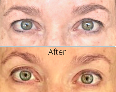 HIFU brows and eye bags