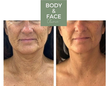 Face instant results hifu_edited.jpg