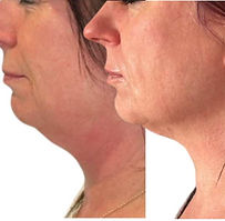Lady in 50's jawline aqualyx injections_edited.jpg