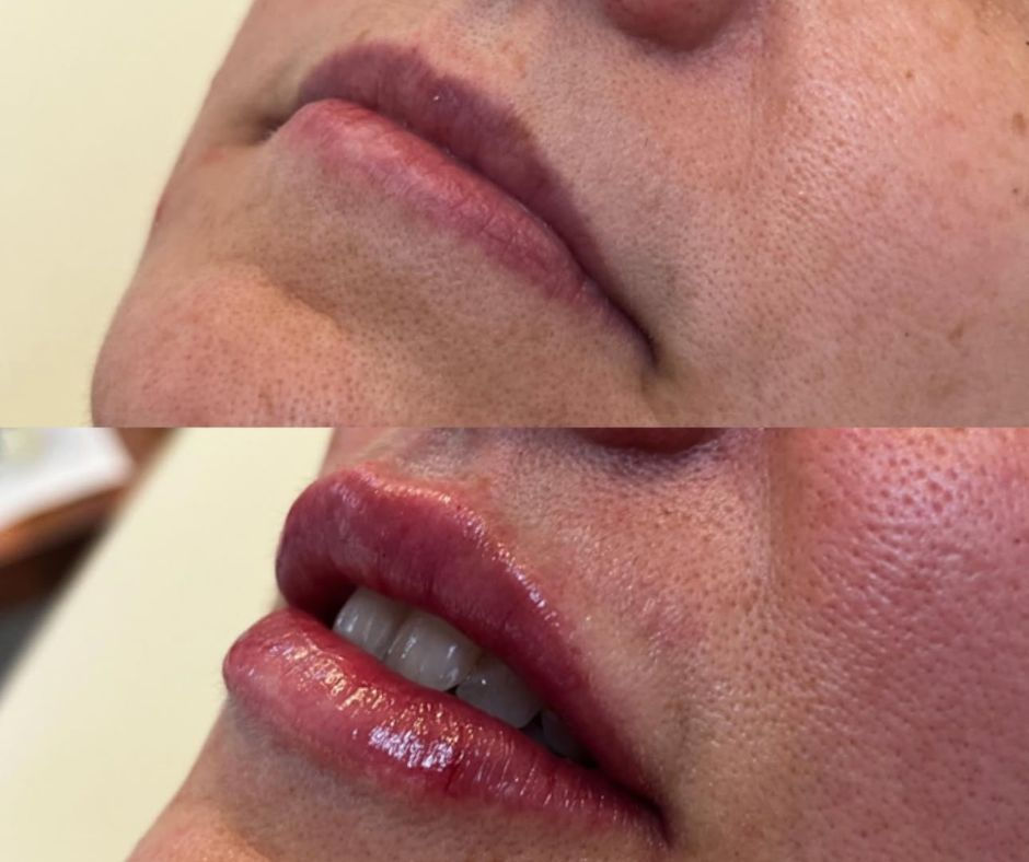 Close-up of lips before and after enhancement. Upper image shows natural lips, lower image shows glossy, fuller lips. Beige background.