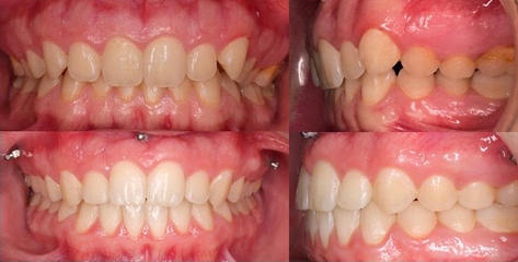 braces-venetoClinic-04.jpeg