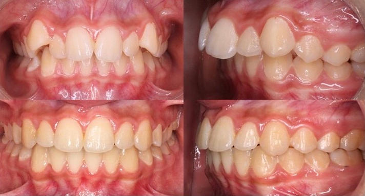 braces-venetoClinic-02.jpeg