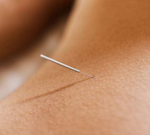 Woman Receiving Acupuncture_edited.jpg
