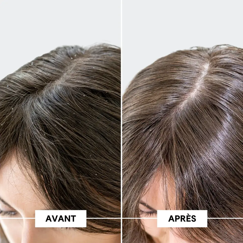 Avant/Après: cheveux avec pellicules, puis sans pellicules