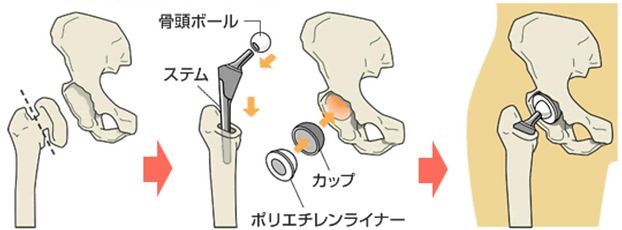 千葉白井病院 全人工股関節置換術