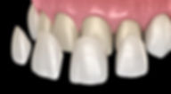 Veneer images.jpeg