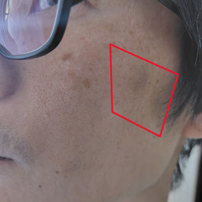 美容鍼をするにあたって注意すべき危険なこと