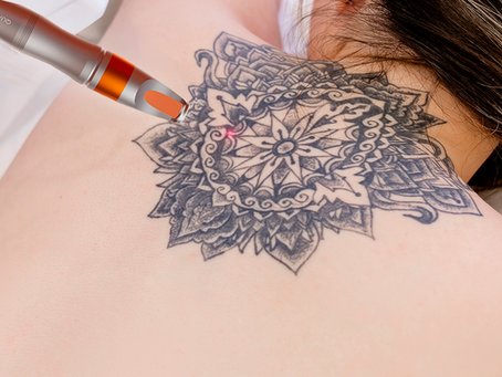 Tecnologia, resultados e recuperação na remoção de tatuagens
