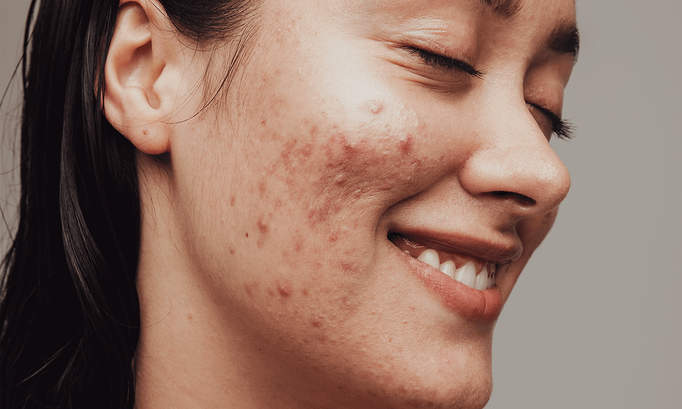 best korean products to fight pimples acne korea skincare trouble skin