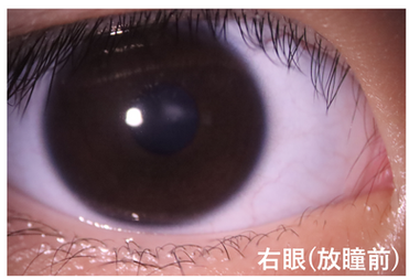 先天性白內障