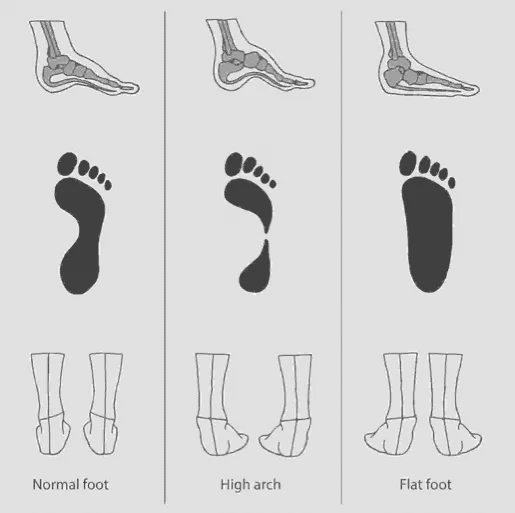 Kenali tipe kaki anda sebelum membeli sepatu running, karena ini sangat mempengaruhi kenyamanan