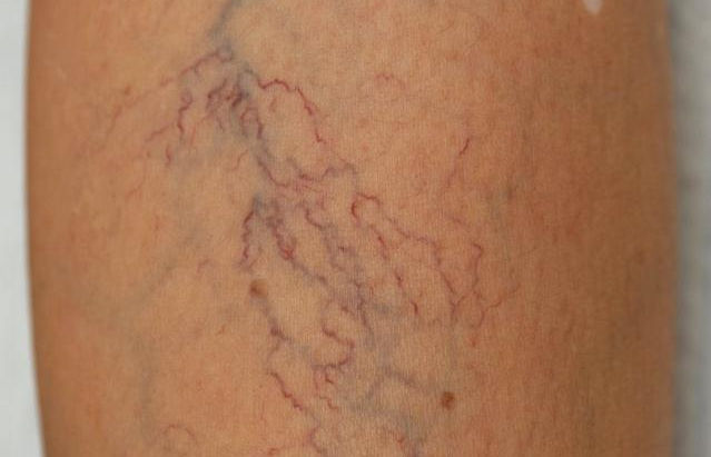 Spider Veins Treatment: What Are They and How Can You Get Rid of Them?