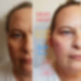 Cheek fillers aren't just for creating c
