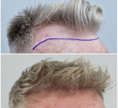 FUE hair transplant results Manchester – frontal hairline
