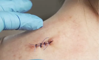 healing stitches.webp